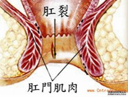 福州肛裂医院排行榜—福州治疗肛裂专业的医院_网上预约挂号