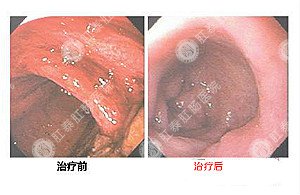 福州结肠炎专业治疗方法