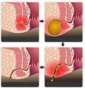 福州医博怎样治肛瘘？