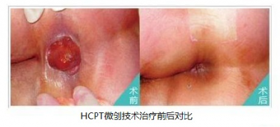 福州外痔会便血吗