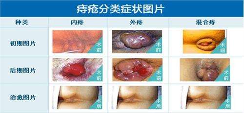 福州做内痔手术疼吗