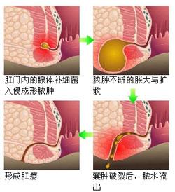 福州治痔疮和肛瘘的方法