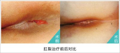 福州肛裂好治疗吗