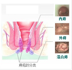 福州得了痔疮该怎么办