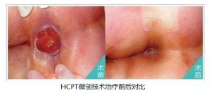 福州得了痔疮该怎么办