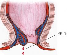 福州大便出血了该怎么办啊？