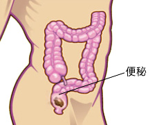 福州便秘专科