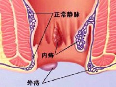 福州痔疮不手术能吗