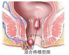 福州哪个医院治环形混合痔好？