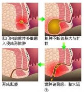 福州看肛瘘去哪个医院专业