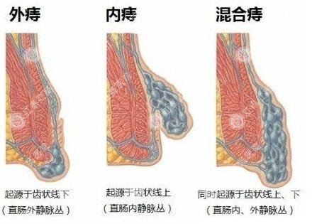 泉州痔疮治疗较好的医院