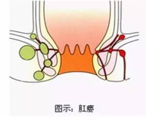 治疗肛瘘专业方法是什么