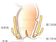 肛裂症状