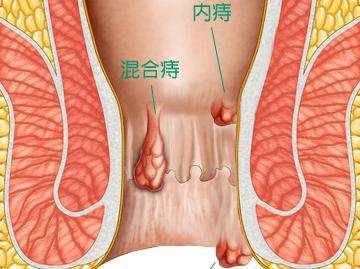 得了痔疮怎么办？痔疮的专业治疗方法