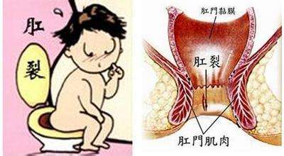 福州治痔疮去哪个医院好