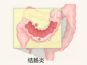 福州结肠炎的治疗方法是什么